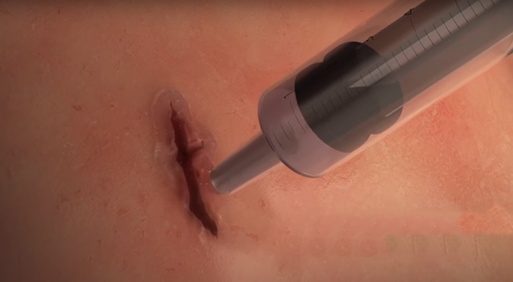 С помощью хирургического клея рана затянется за минуту