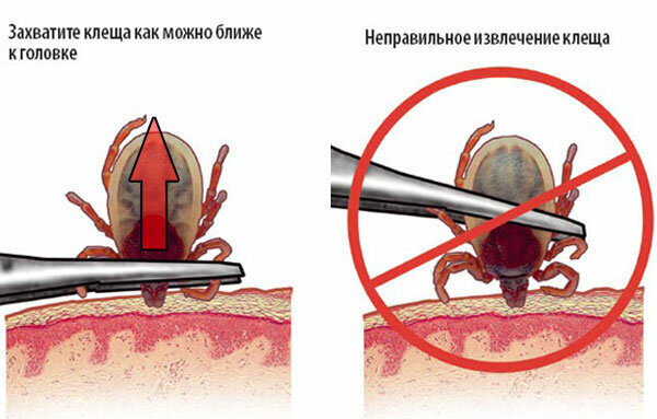 Как безопасно удалить клеща?