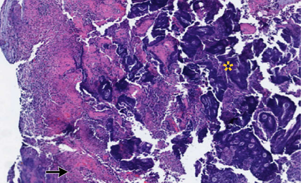 Моноклональные антитела показали действенность против рака прямой кишки