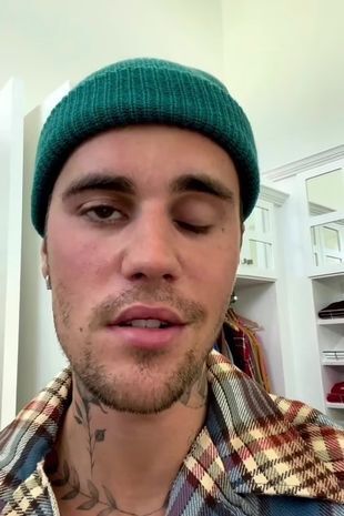 Известного певца поразил лицевой паралич из-за синдрома Рамзи Ханта