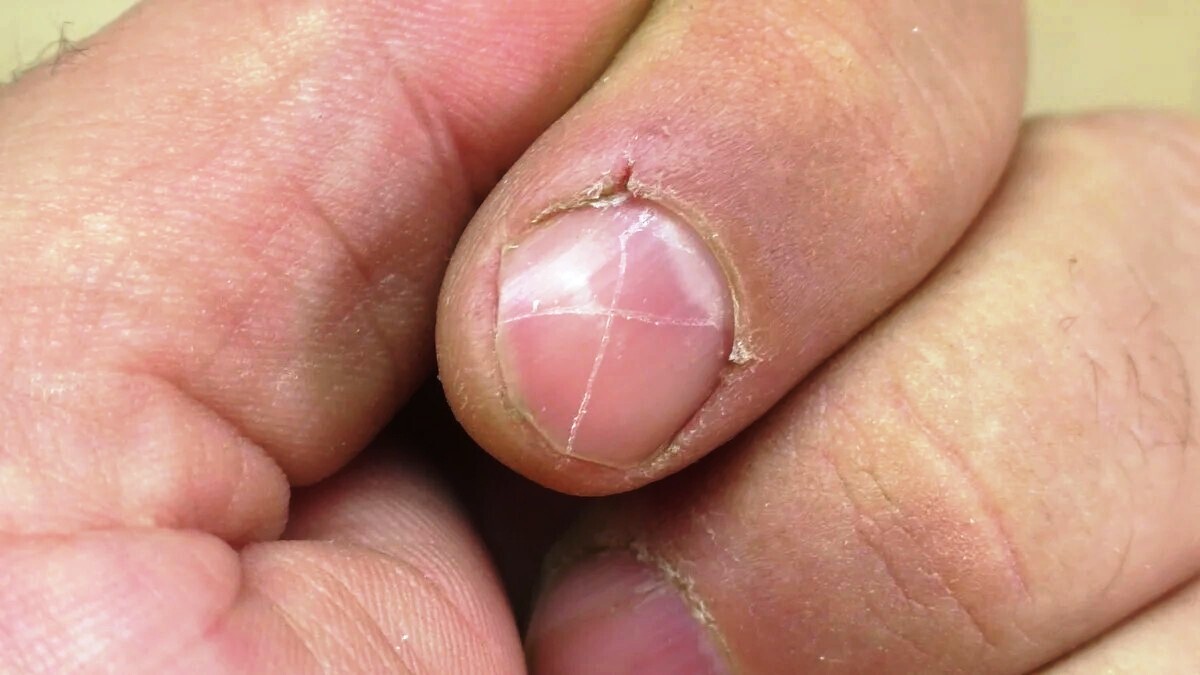 Волшебный способ, который быстро избавит вас от заусенцев на пальцах. Показала бабушка, теперь только им и спасаюсь