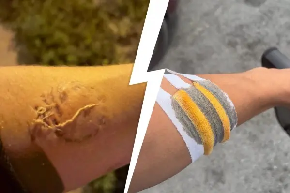 Печальный результат знакомства в соцсетях и романтического свидания. "Она вцепились в мою руку зубами и старалась выдрать из неё "кусок мяса"