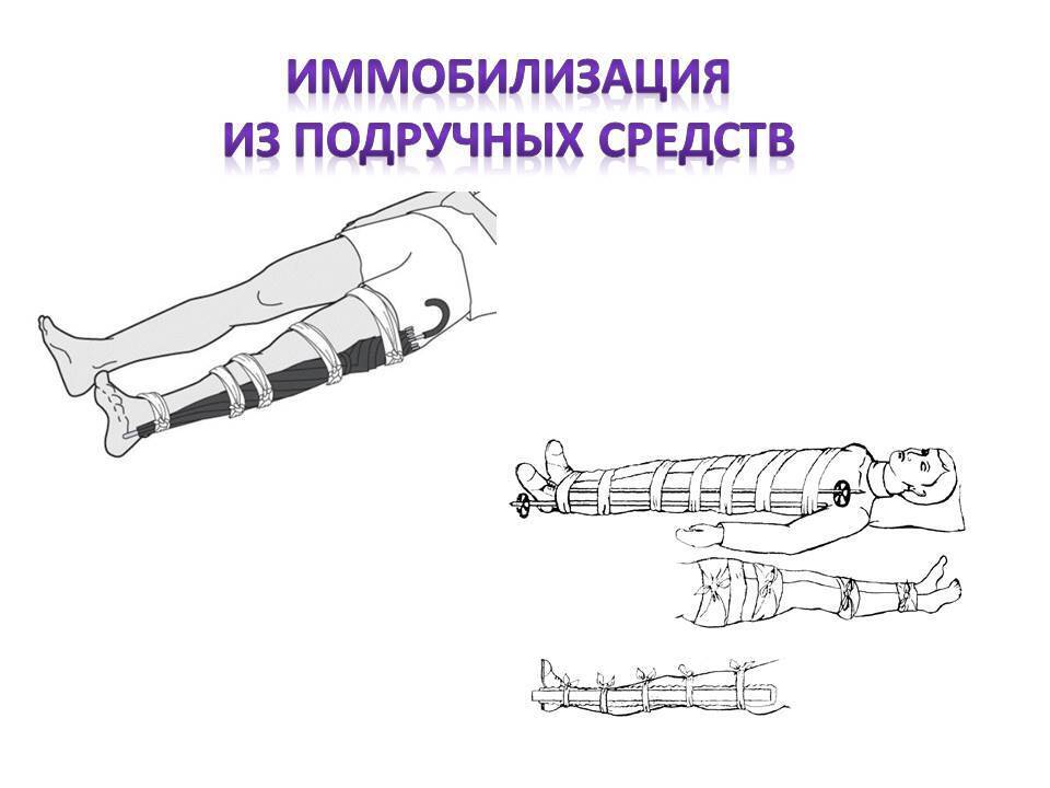 Иммобилизация, как вести себя до приезда медиков