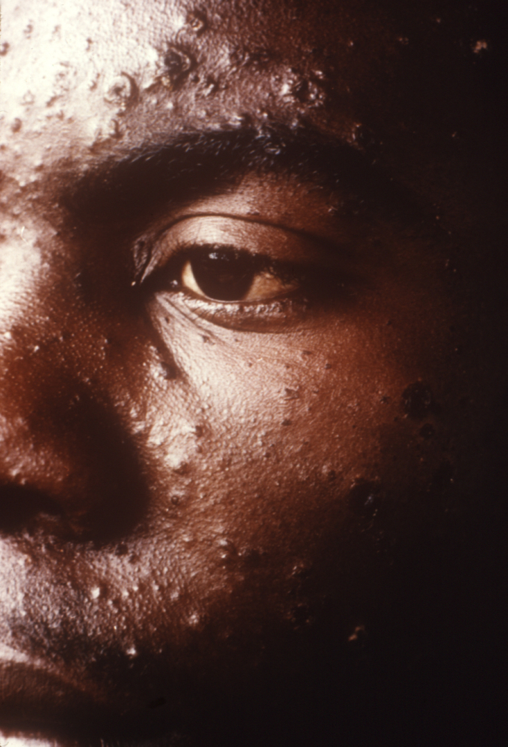 Самые наихудшие пандемии в мировой истории и как они закончились