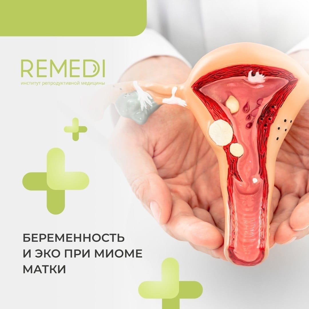 Беременность и ЭКО при миоме матки