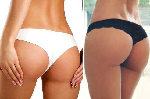 Пластика ягодиц: виды и особенности глютеопластики