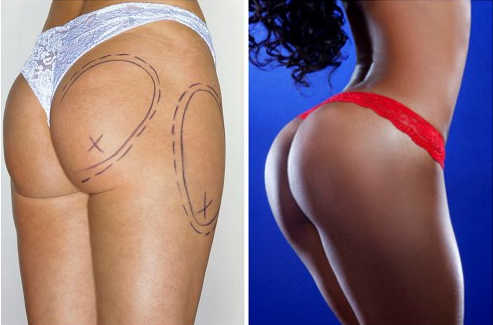 Пластика ягодиц: виды и особенности глютеопластики