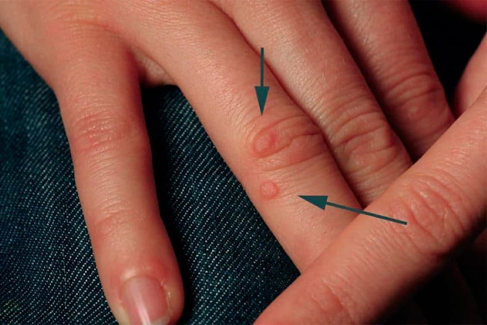 Как избавиться от бородавок на пальцах с помощью эффективных средств?