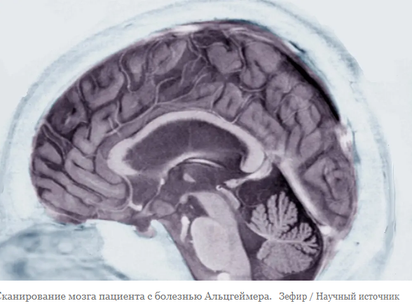 Лекарство от болезни Альцгеймера может принести пользу некоторым пациентам, показывают новые данные