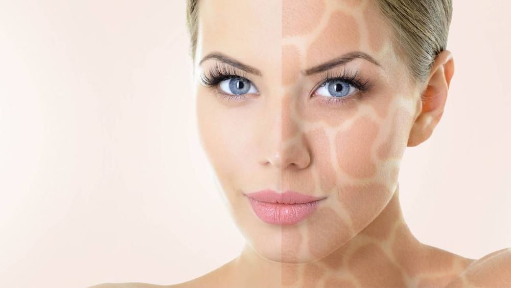 Какие ингредиенты должны быть в составе эффективного крема от гиперпигментации?