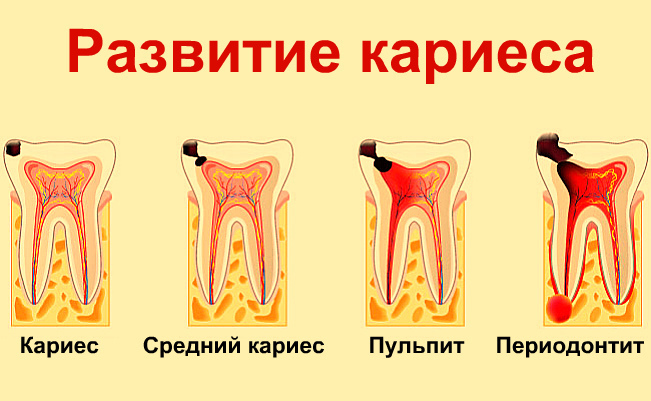 Клиническая картина среднего кариеса