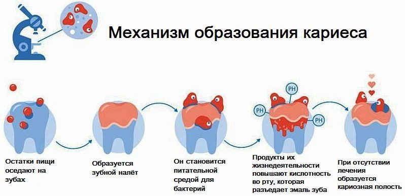 Схема лечения кариеса