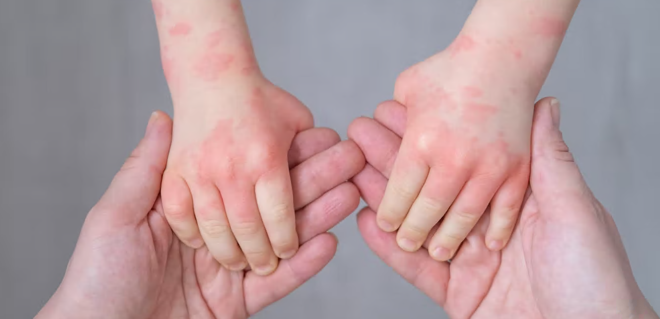 Холодная погода вызывает зуд, раздражение, сухость и шелушение кожи — вот как лечить экзему и другие кожные заболевания и когда обратиться к врачу