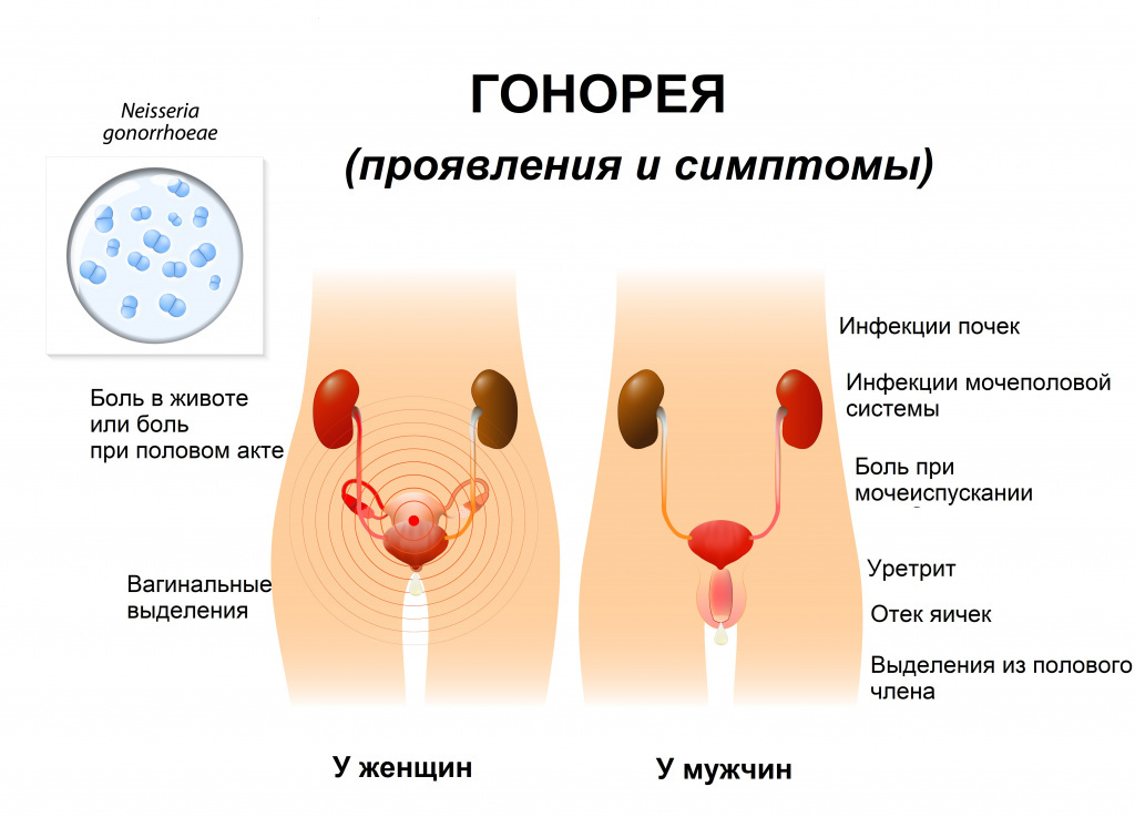 Что такое гонорея?