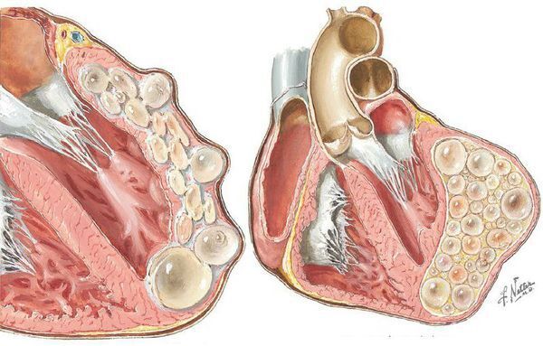 Справочник фельдшера.Справочник фельдшера. Эхинококкоз- хроническая болезнь