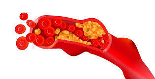 Артериосклероз И Атеросклероз: Симптомы, причины, лечение. Часть2