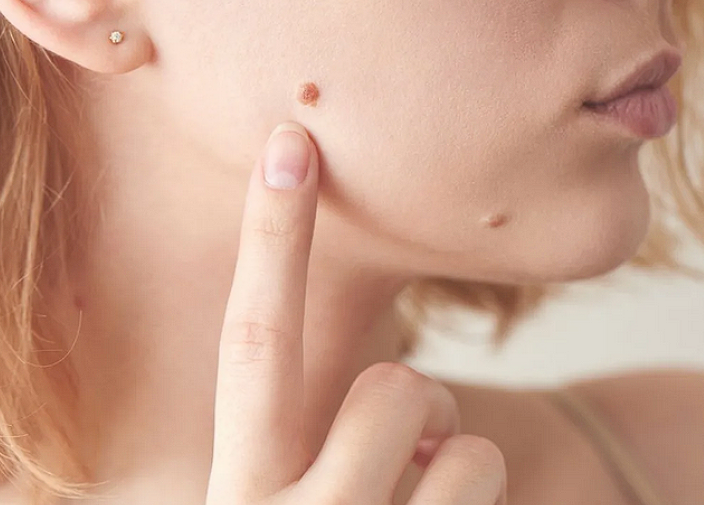 Как избавиться от бородавки, бабушкин метод который помогал мне всю жизнь!