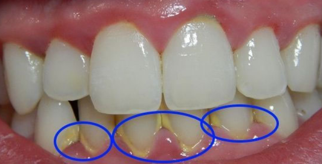 Как легко удалить бактериальный налет и зубной камень с зубов за 5 минут без посещения стоматолога