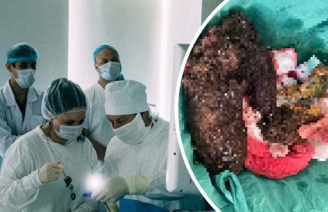 Девушка ела свои волосы.