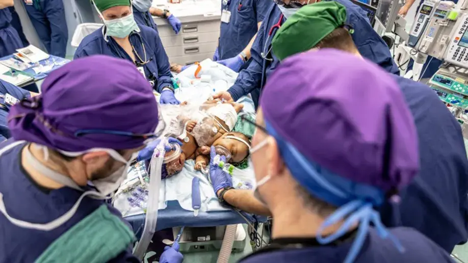 Девочек-близнецов разделили в Техасской клинике после успешной операции.