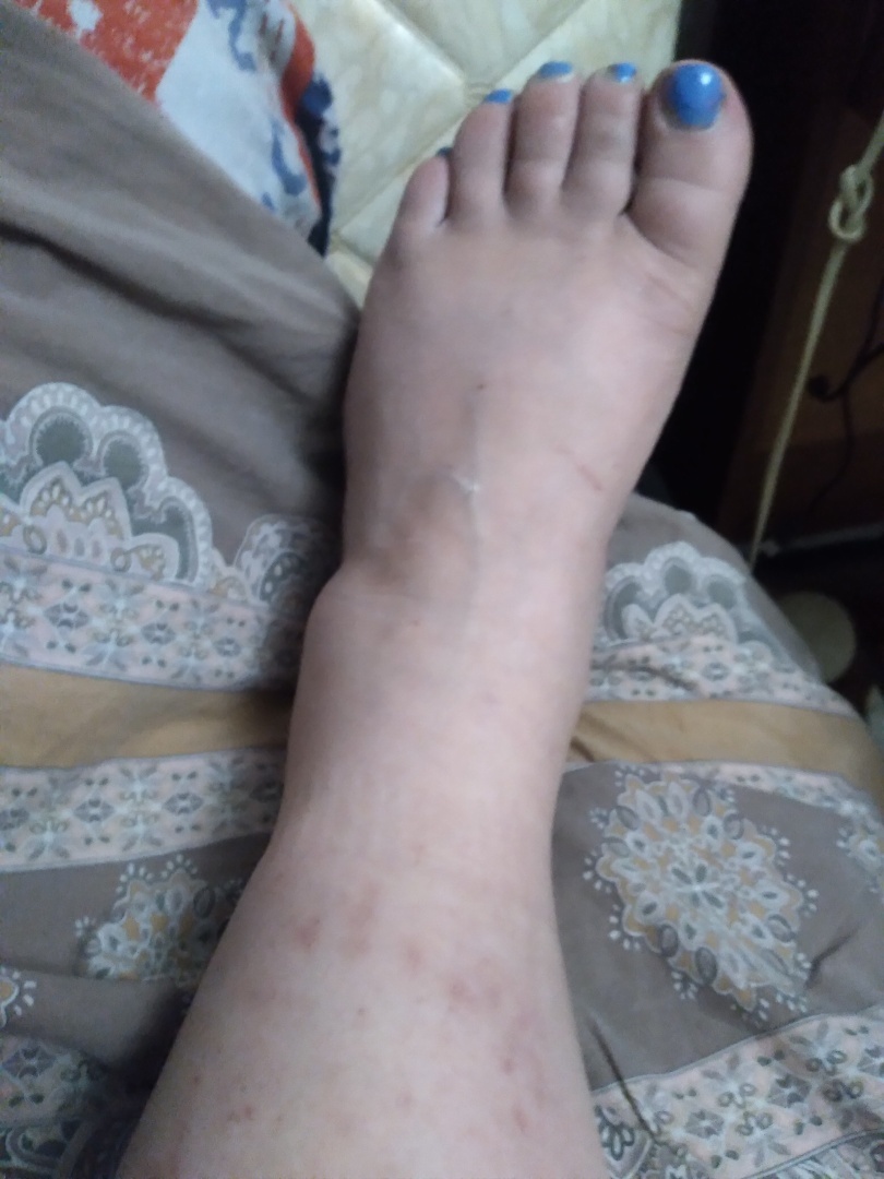 ПСОРИАЗ ,СРАВНЕНИЕ И РЕАЛЬНЫЕ РЕЗУЛЬТАТЫ отечественных, мазей и китайских .Хочу обратить внимание, что после 3х ковидных прививок ,...