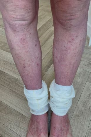 Женщина потеряла свою красоту, после того как крем от экземы "сжёг" её кожу по всему телу.