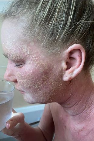 Женщина потеряла свою красоту, после того как крем от экземы "сжёг" её кожу по всему телу.