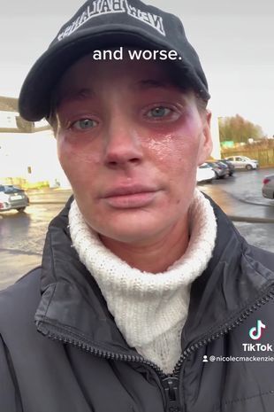 Женщина потеряла свою красоту, после того как крем от экземы "сжёг" её кожу по всему телу.