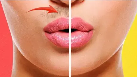 Лазерная эпиляция верхней губы.