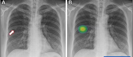 Инструмент рентгеновского скрининга ИИ