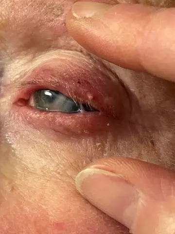 Врачи ожидают больше инфекций от испорченных глазных капель, которые были отозваны.