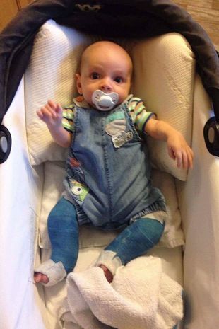 Ребёнку пришлось ампутировать ноги из-за жестокого обращения матери.