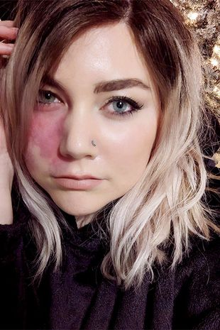 Мое родимое пятно не делает меня слишком уродливым для свиданий