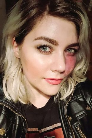 Мое родимое пятно не делает меня слишком уродливым для свиданий