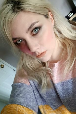 Мое родимое пятно не делает меня слишком уродливым для свиданий