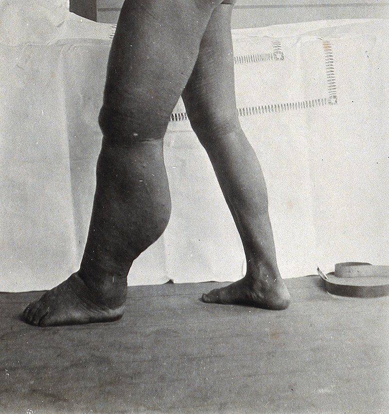 Самые страшные болезни человечества Топ 10