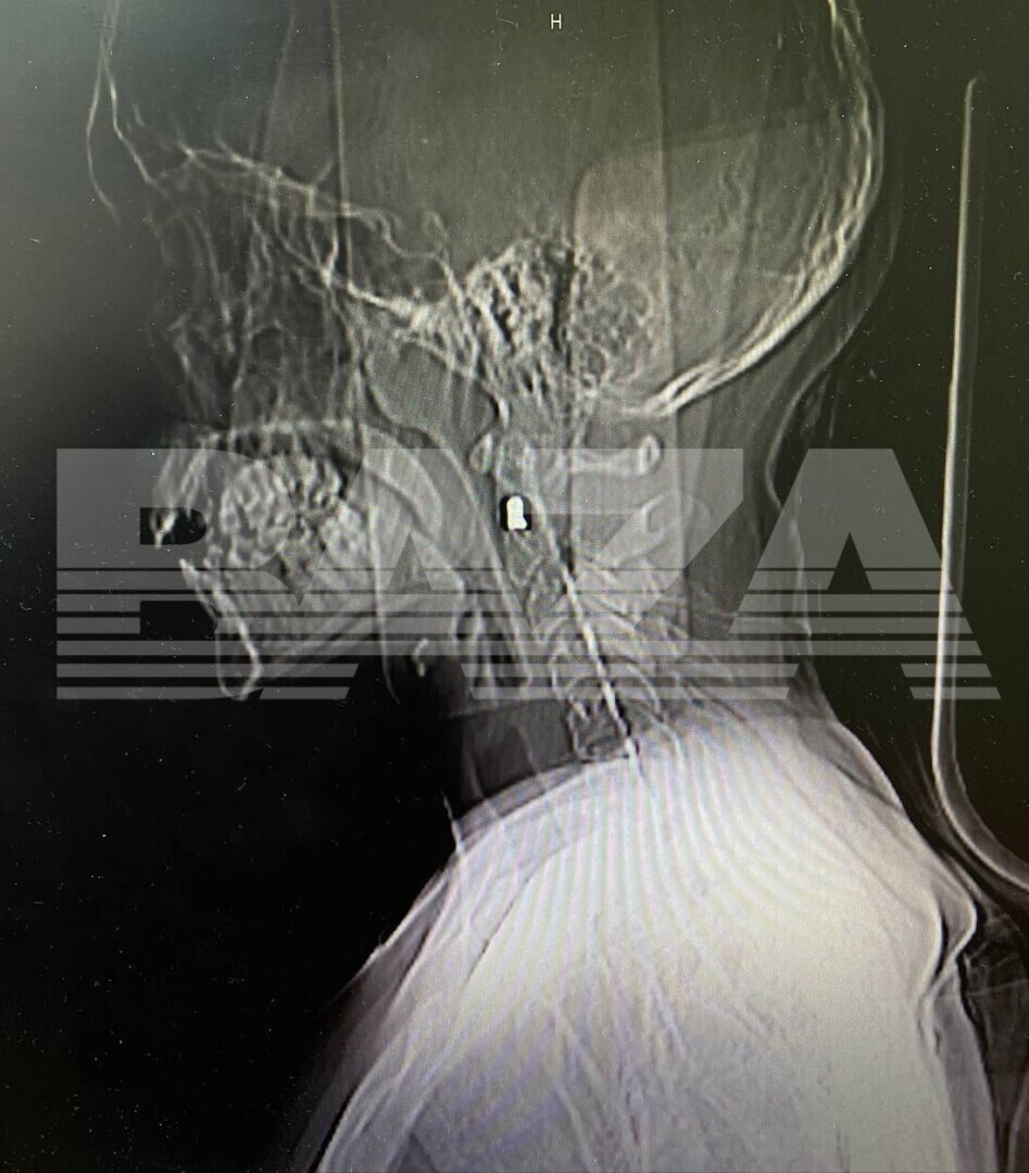 Полгода проходила в пулей в сонной артерии.