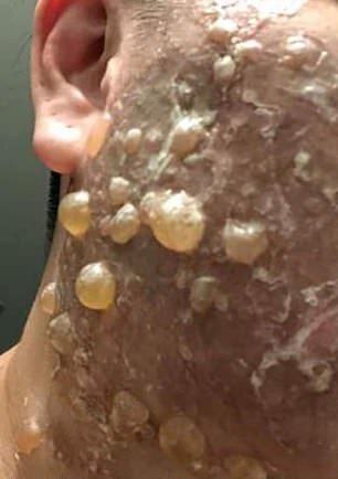 "Пластическая операция прошла неудачно: женщина госпитализирована с сильными ожогами после косметической процедуры в Тайваньской клинике"