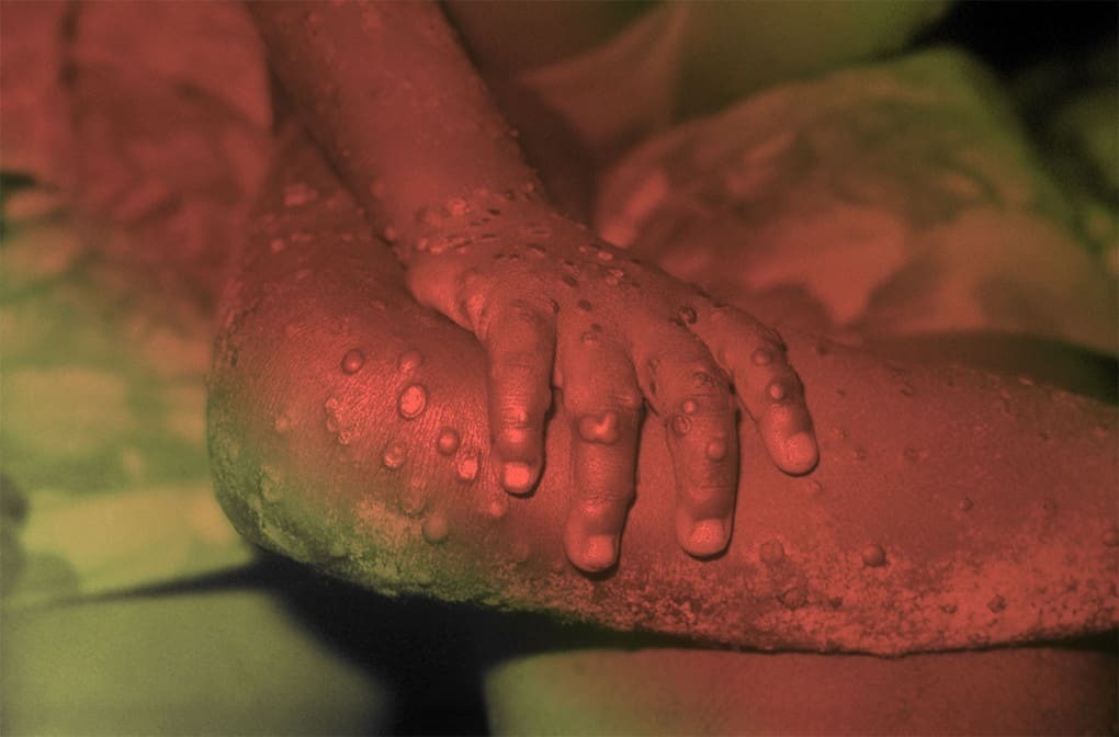 Самые страшные болезни человечества Топ 10