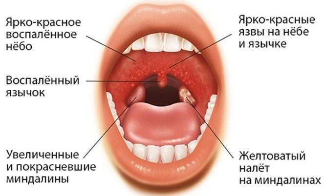 Ангина в разной форме. Как ее вылечить быстро и эффективно?