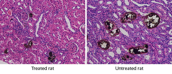 Вот как лимонный сок может бороться с камнями в почках