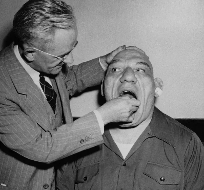 Акромегалия: симптомы, лечение и причины