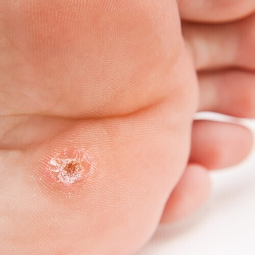 Как бороться с бородавками