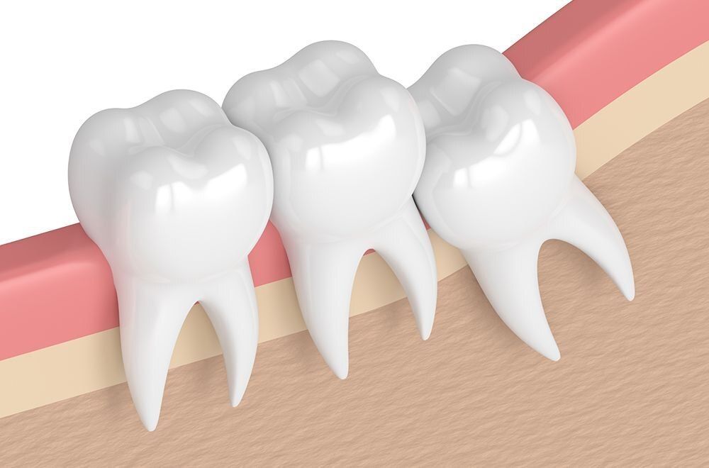 Зуб мудрости