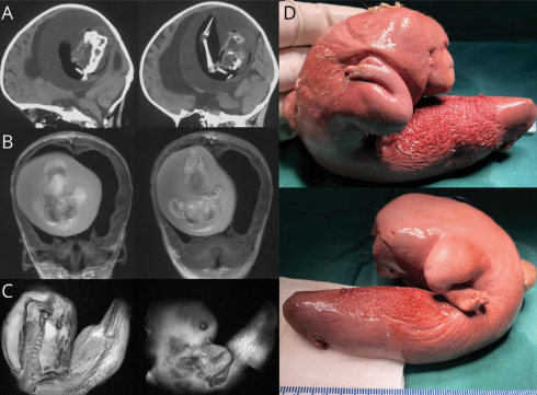 Из мозга годовалой девочки удалили нерожденного близнеца.