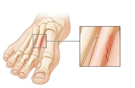 Немного про стресс-перелом