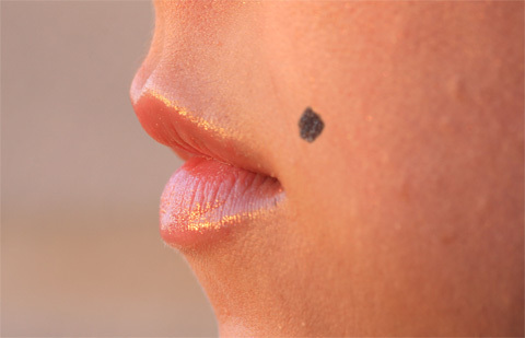 Появление родинки- чем это опасно?