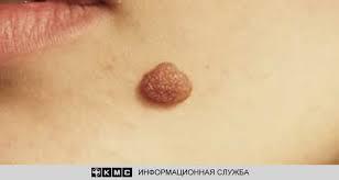 Появление родинки- чем это опасно?