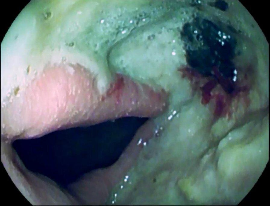 Боитесь гастроскопии?! Не её вам нужно бояться!!!