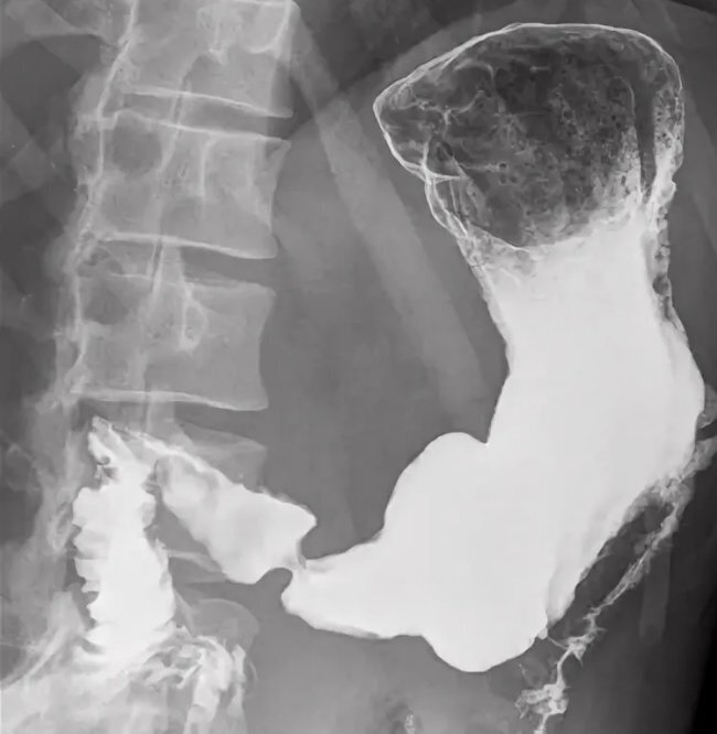 Рентген с контрастом. Контрастирование желудка рентген. Сульфат бария рентген желудка. Стриктура желудка рентген. Рентген желудка с барием грыжа.